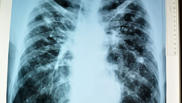 В Минздраве прокомментировали информацию о туберкулёзе у сотрудницы перинатального центра
