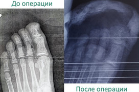 Травматолог предупредила о костной опухоли, которую путают с вросшим ногтем