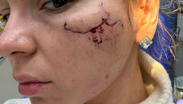 Кировчанке разбили лицо стаканом и пригрозили безнаказанностью