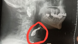 Кировские врачи извлекли зубной протез из горла пациентки