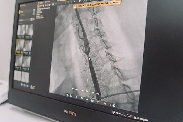 Кировские хирурги использовали ангиографический комплекс для проведения уникальной операции