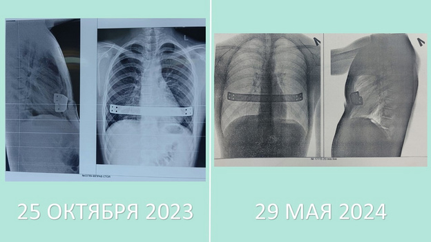 Кировские врачи вылечили подростка с деформацией грудной клетки