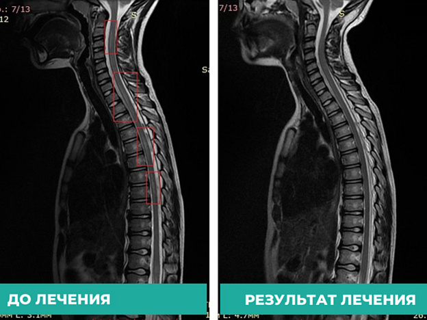 В Кирове врачи спасли ребёнка с воспалением спинного мозга