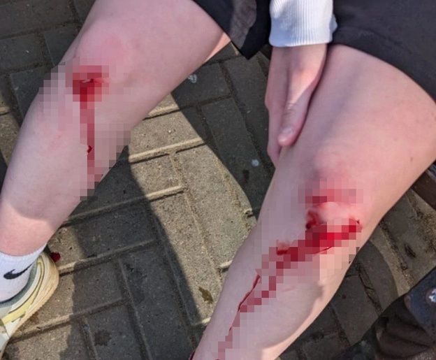 В Кирове девочка травмировалась из-за плохого содержания фонтана