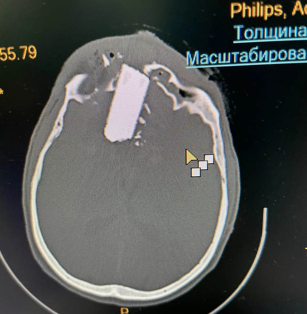 Кировские врачи спасли мужчину с крупным осколком диска в черепе