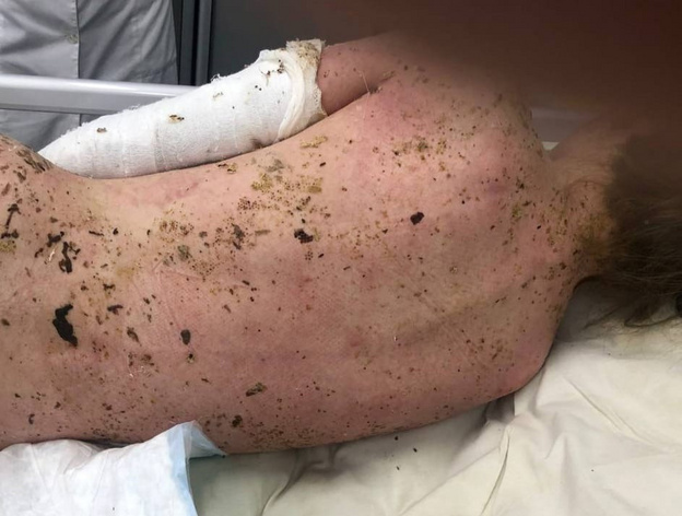 Почти 100% поражения тела: кировские врачи спасли 16-летнюю девушку с острой аллергической реакцией