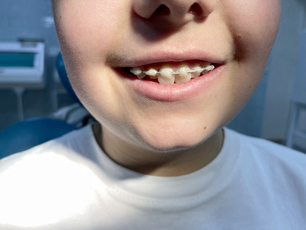 В Кирово-Чепецке хирург спас подростку выбитый зуб