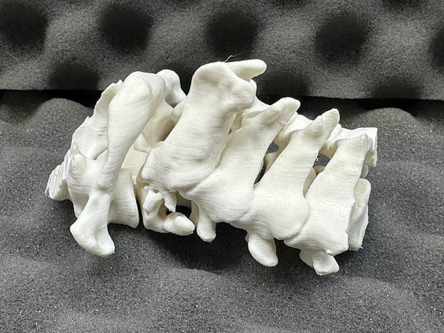 Кировские нейрохирурги спасли мужчину с редкой травмой шеи после ДТП