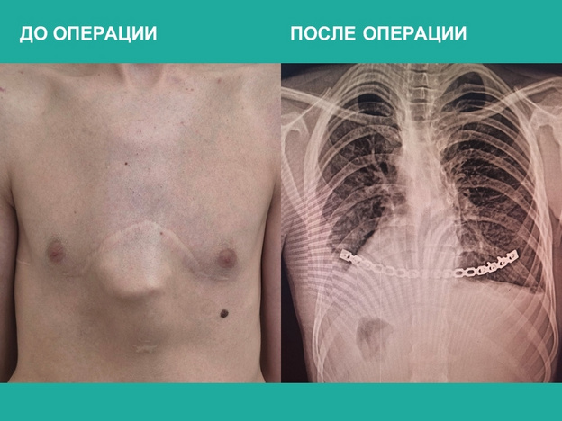 В Кирове прооперировали подростка с килевидной деформацией грудной клетки
