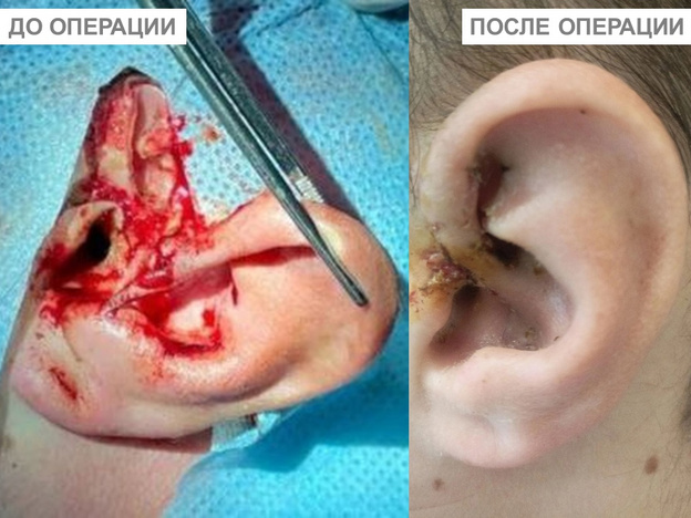Кировские врачи пришили велосипедисту оторванное ухо