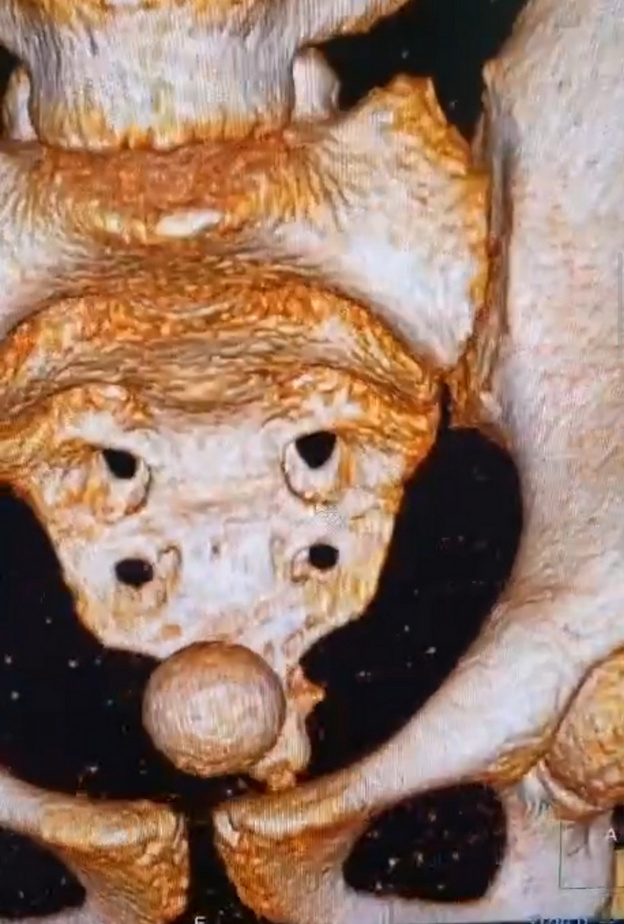 Врачи достали мячик из таза 11-летней девочки в Кирове