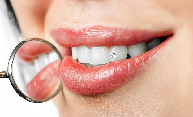 Бриллианты на зубах: что такое скайсы и насколько они безопасны?