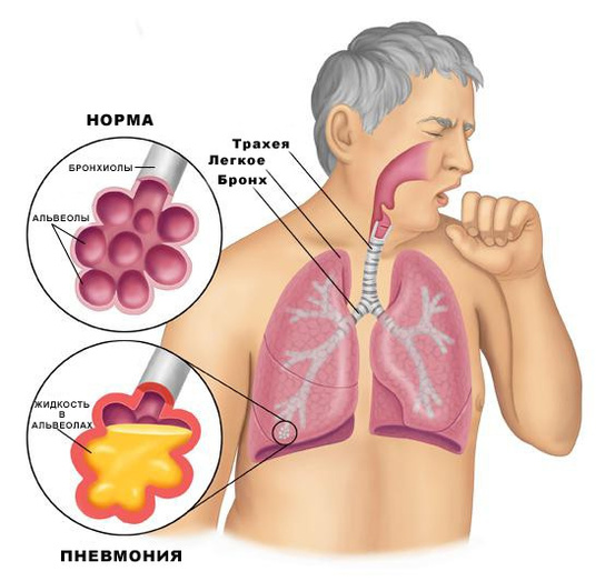 Коварная пневмония: как вовремя распознать заболевание?