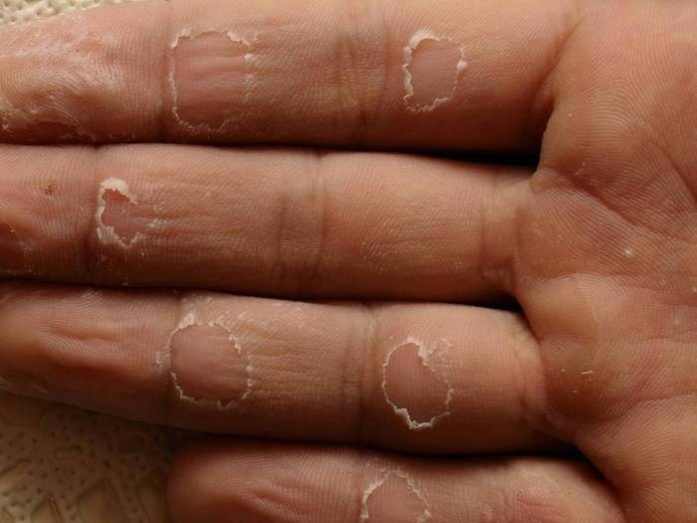Что делать, если трескается кожа на сгибах пальцев?
