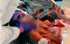 В Красногорске 10-летний мальчик получил тяжелые травмы от взрыва самодельного устройства