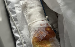 Состояние пострадавшего от взрыва в Красногорске остаётся средней тяжести