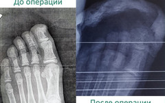 Травматолог предупредила о костной опухоли, которую путают с вросшим ногтем